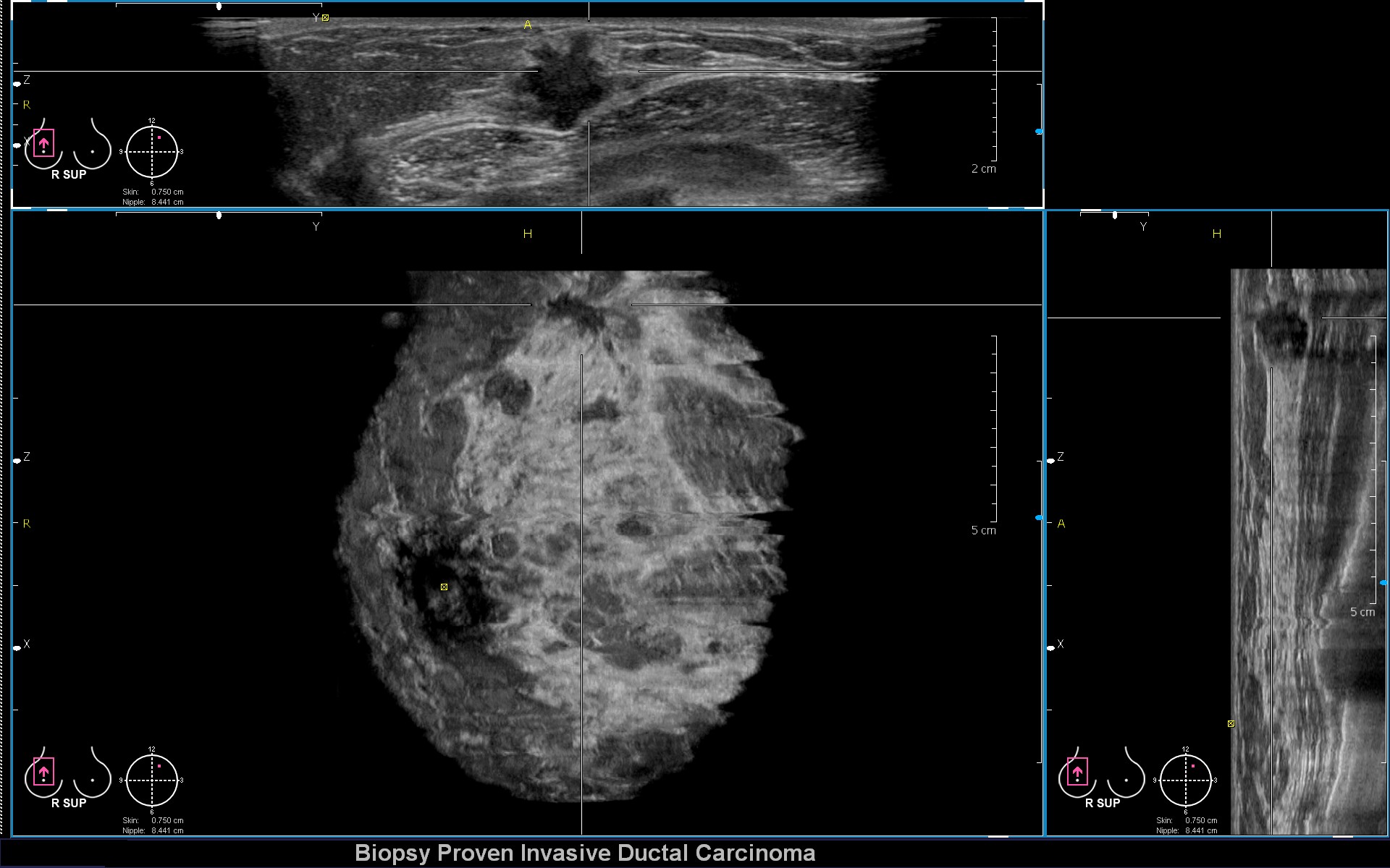 3D Breast Ultrasound Solutions from Siemens Healthineers Cassling
